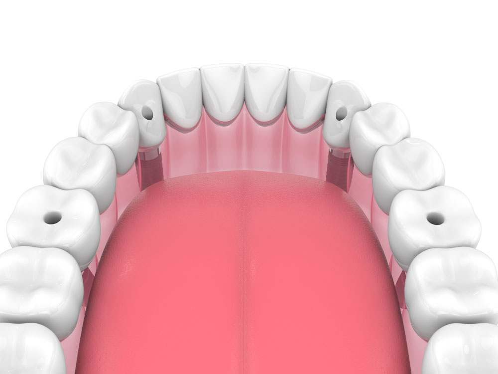 replace missing tooth