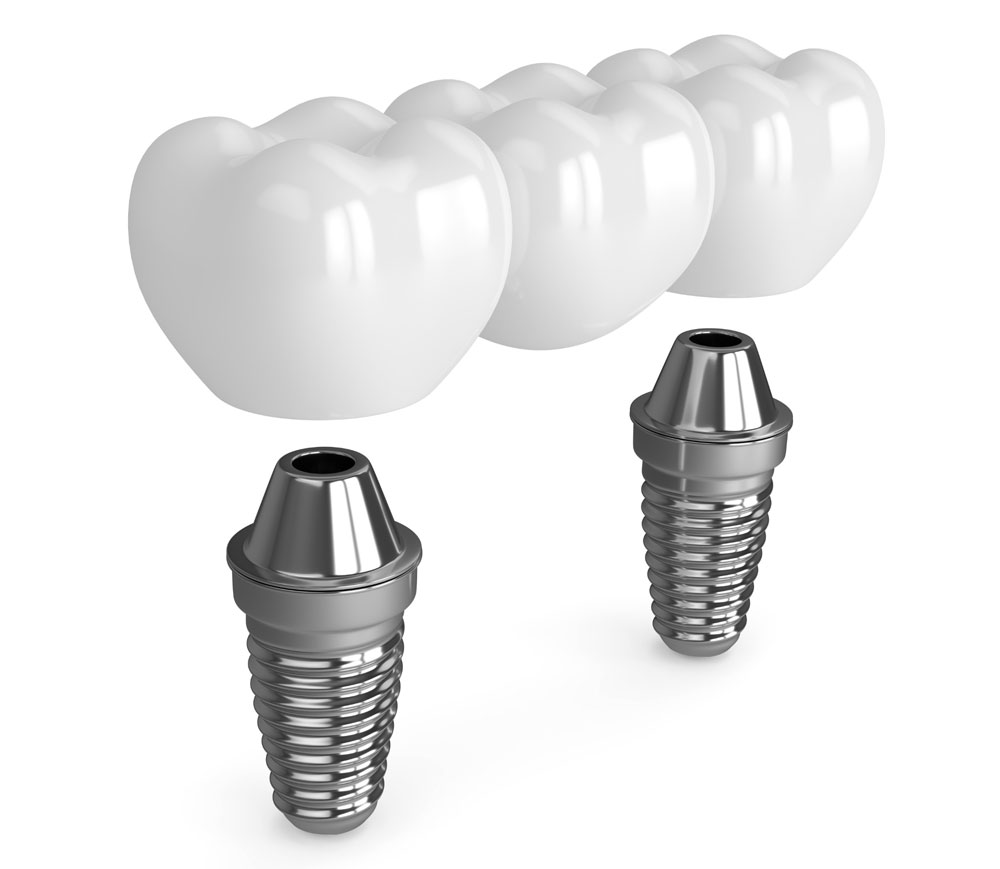 multiple teeth implants