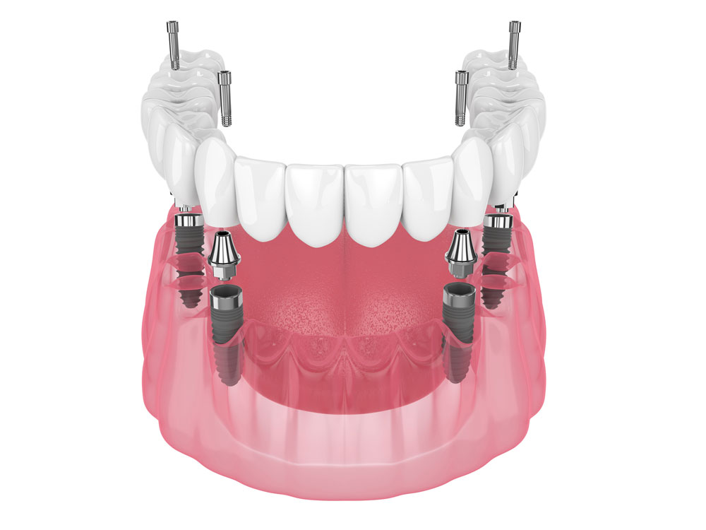 full arch implants