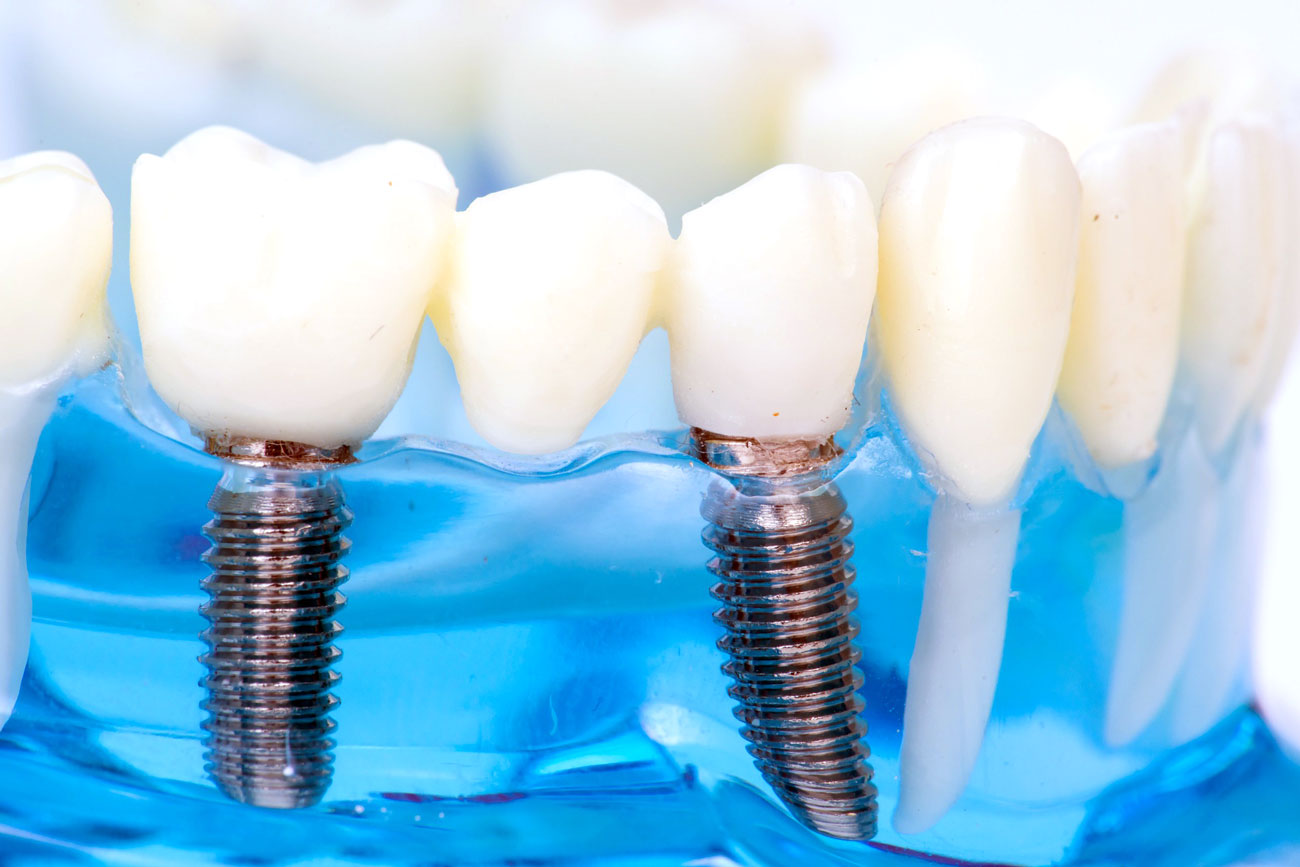 full-mouth-dental-implants