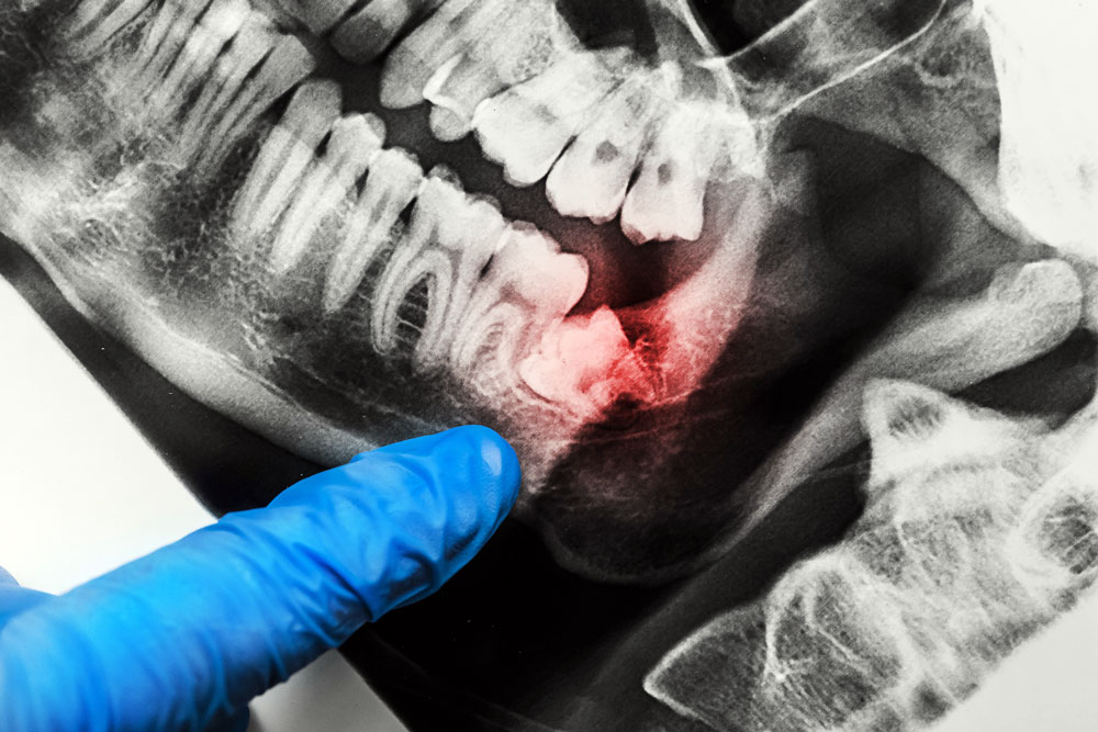 wisdom tooth extraction