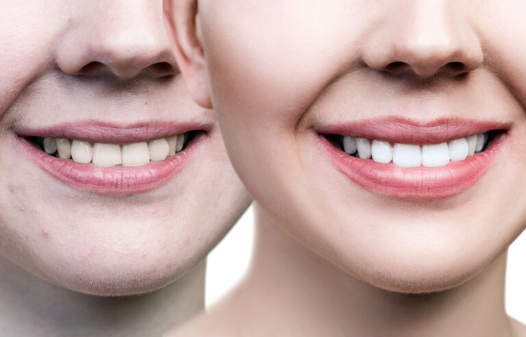 Dentures in Gold Coast, Full Dentures in Gold Coast, Partial Dentures in Gold Coast.