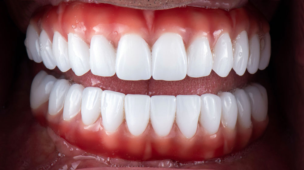 Dental Porcelain Veneers at Bundall dental and implants