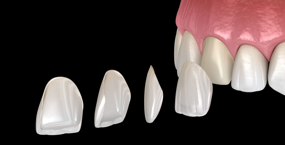 Dental Veneers at Bundall dental clinic