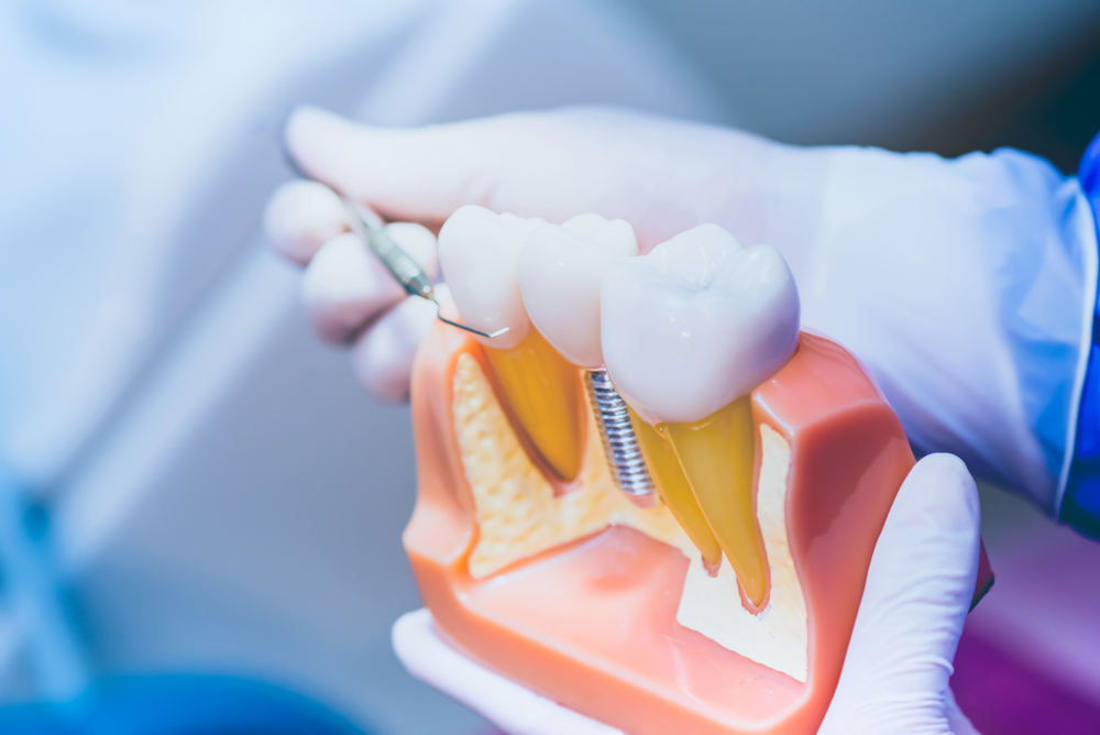 Missing Teeth with Dental Implants