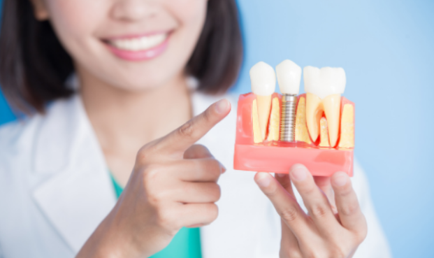 All-on-X vs All-on-4 Dental Implants