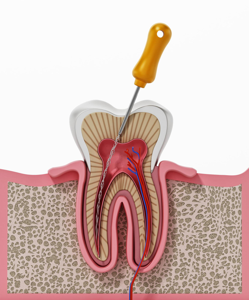 Root Canal Treatment in Gold Coast