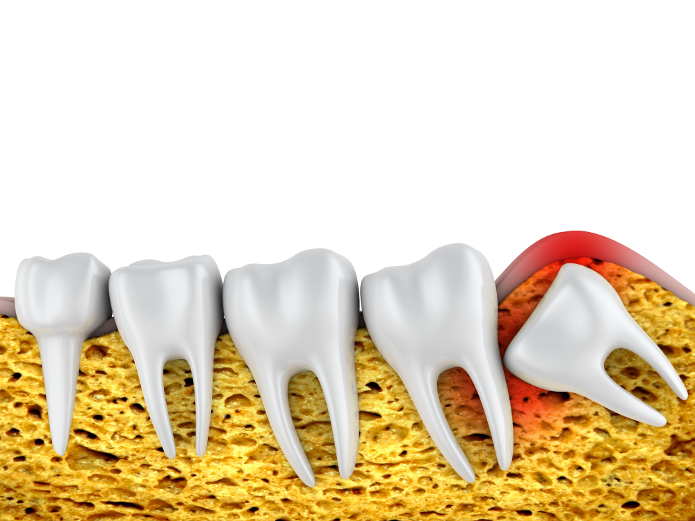 Tooth Extraction Including Wisdom Teeth Removal on the Gold Coast