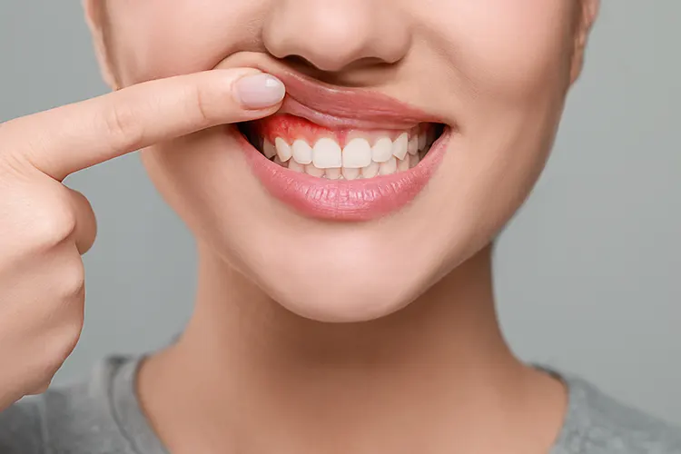 Periodontitis on the Gold Coast