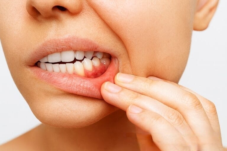 Dental Bridges Infection