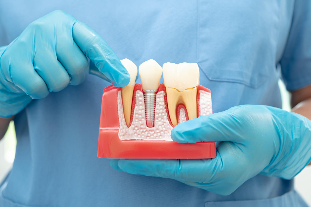 Missing Teeth Replacement