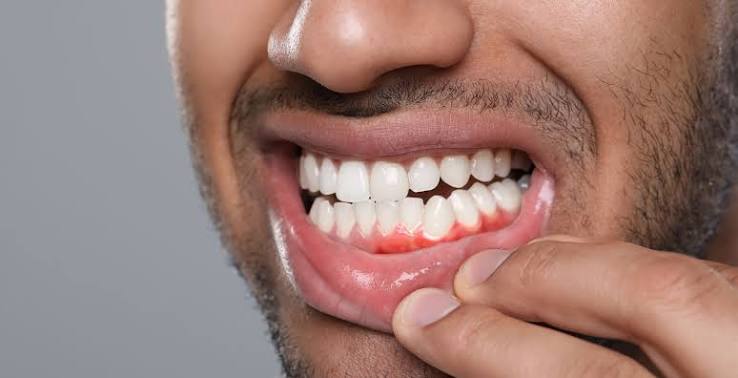 Gum Recession Treatment Options on the Gold Coast