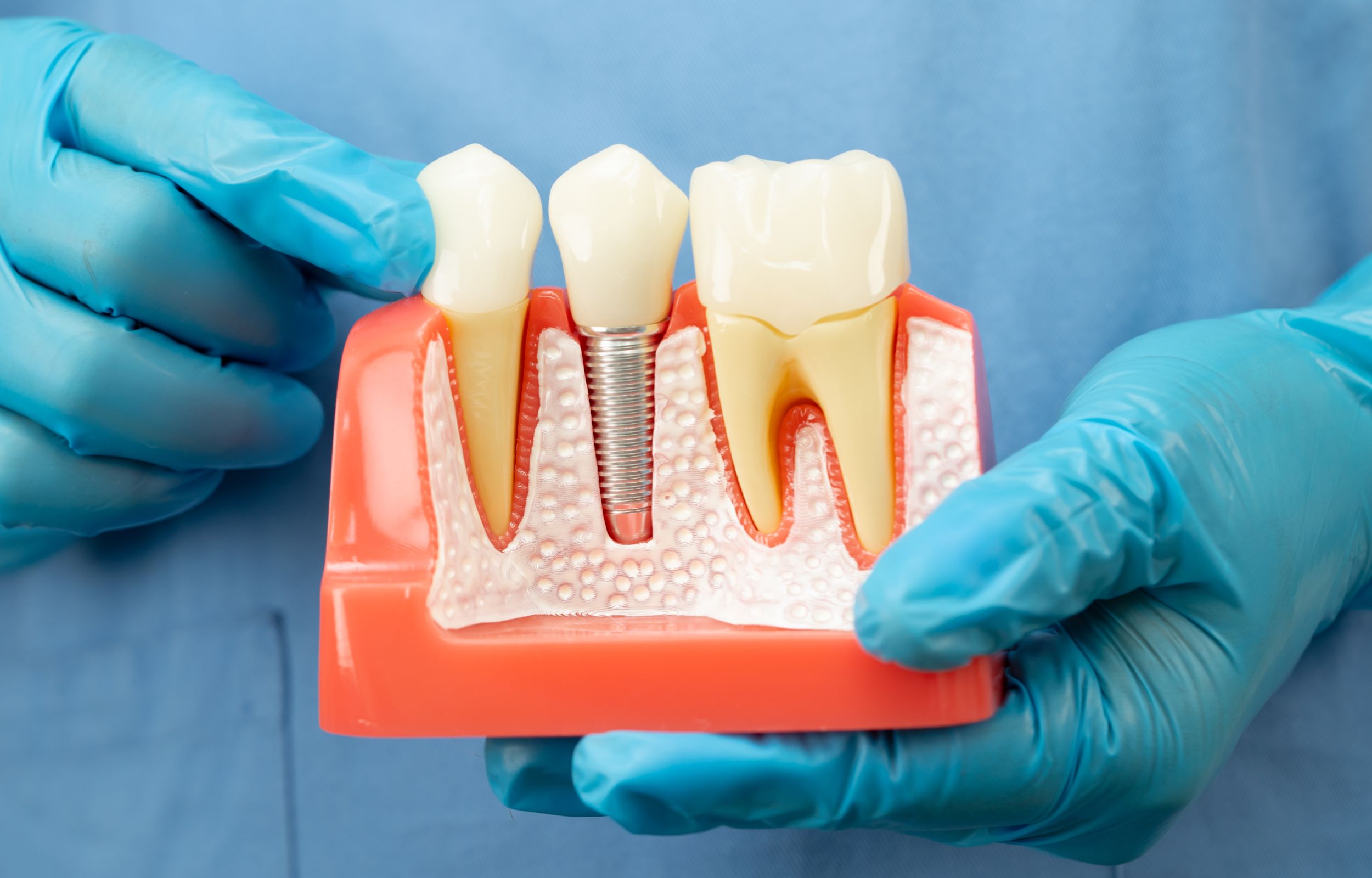 Single-Dental-Implants
