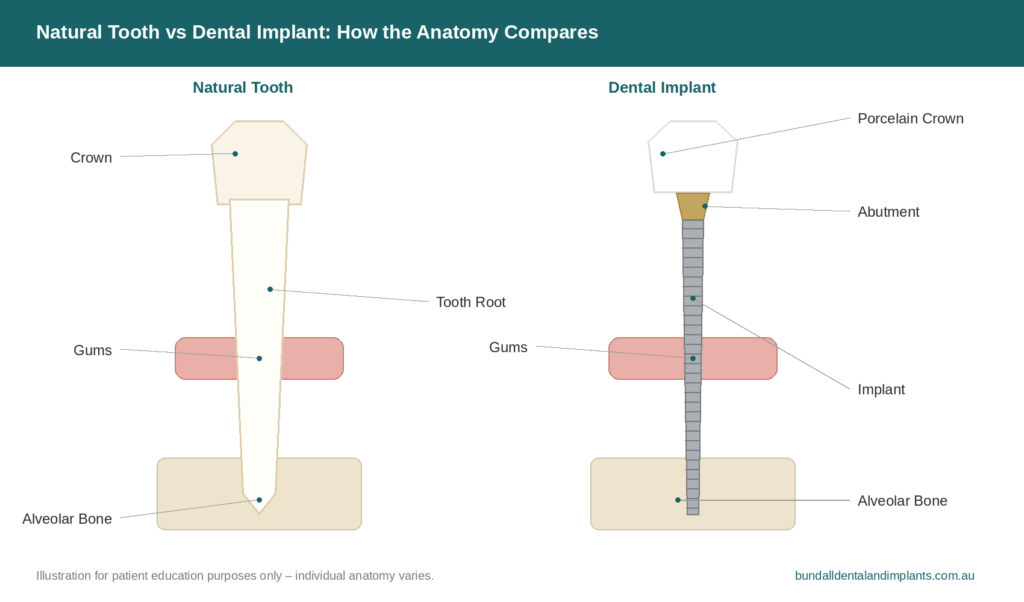 Diagram comparing a natural tooth and a dental implant, illustrating the crown, root, gums, and alveolar bone. This visual aid helps explain dental implants in Gold Coast at Bundall Dental and Implants.