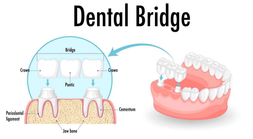 Diagram of a dental bridge showing crowns, pontic, jaw bone, and periodontal ligament.