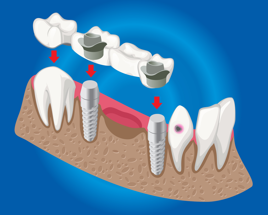 Dental bridge placement on implants, showing implant posts in jawbone and a missing tooth.