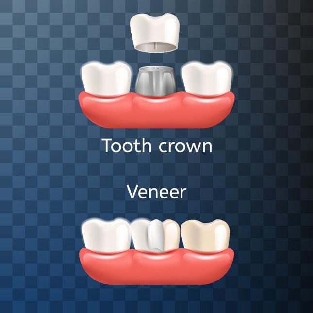 Diagram comparing tooth crown and veneer dental restorations