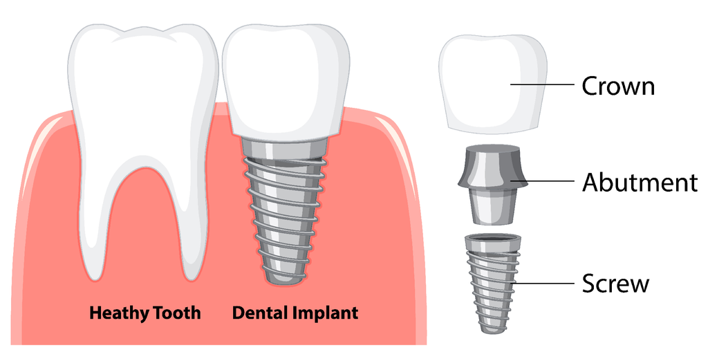 Illustration comparing a healthy tooth to a dental implant, showing screw, abutment, and crown components.