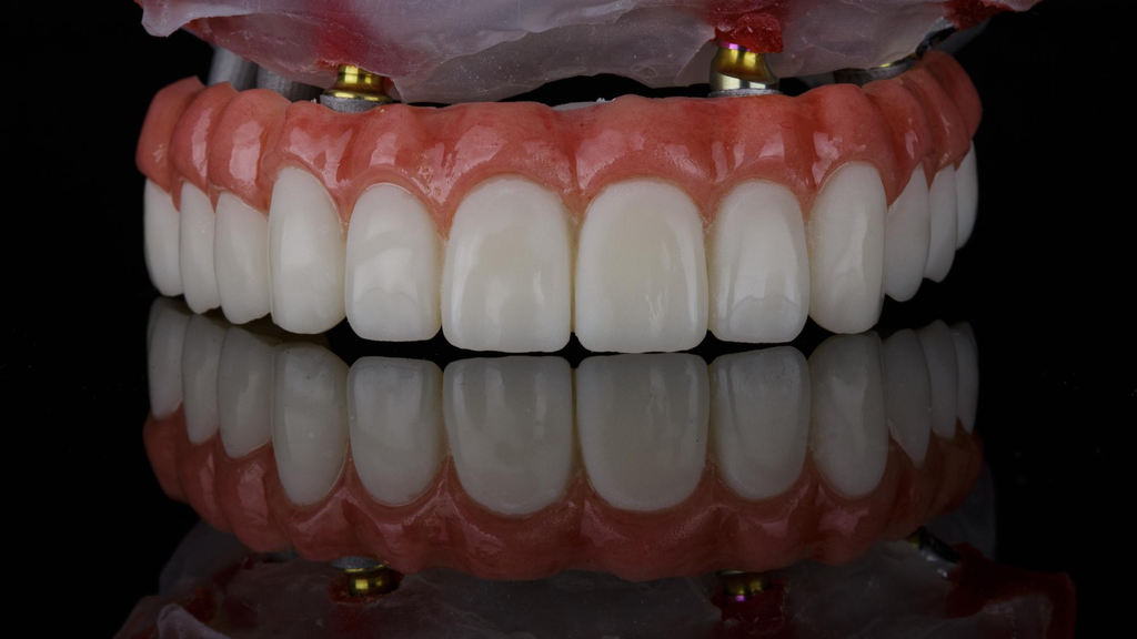 Implant-supported overdenture showing a full set of upper and lower ceramic teeth.