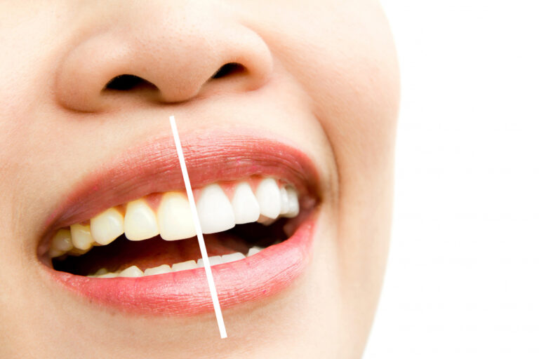 Split image showing a woman's smile: left side displays yellowed teeth, right side shows bright white teeth after professional teeth whitening treatment at Bundall Dental and Implants, a trusted dentist in Gold Coast offering Zoom teeth whitening Bundall and in-chair teeth whitening Bundall.
